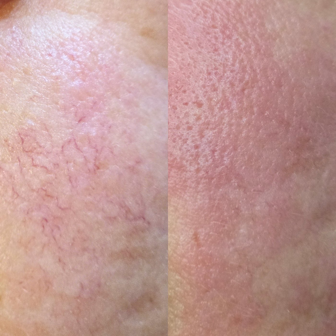 Laser DYE-VL, naczynka i rumień · przed i po