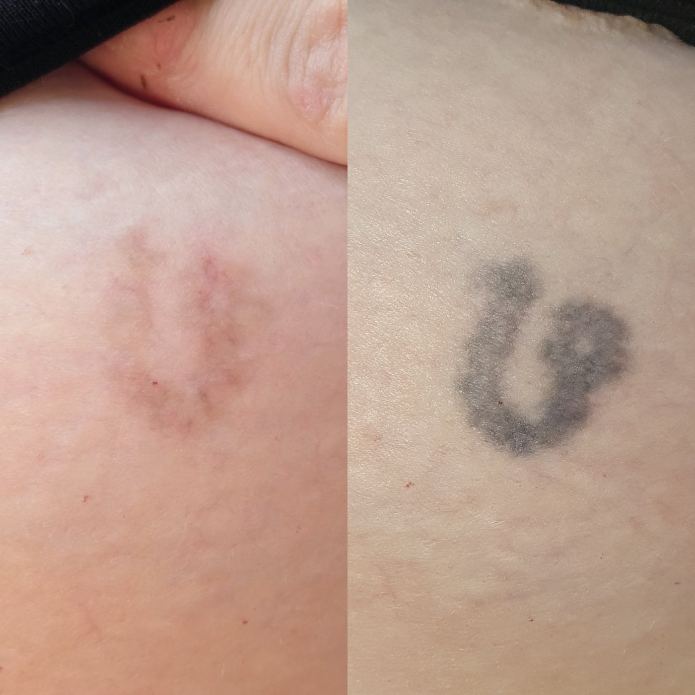 Laserowe usuwanie tatuażu · w trakcie serii